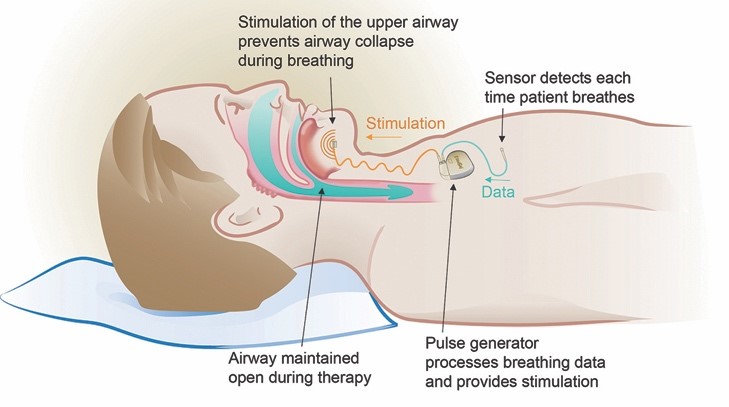 Types of Sleep Apnea Treatment (Include Inspire Upper Airway Stimulation  therapy) » Head & Neck Surgical Associates